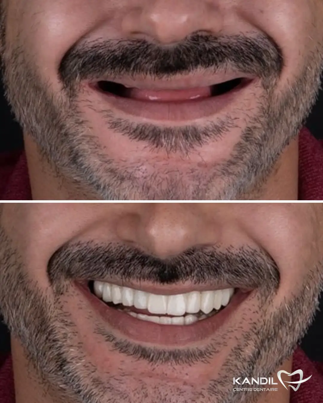 Cas clinique de reconstruction totale de la bouche (Full Mouth Rehab) avant-après. Transformation radicale d'un patient édenté grâce à la pose d'implants dentaires All-on-4 / All-on-6 de dernière génération au Centre Dentaire Kandil à Mohammedia.