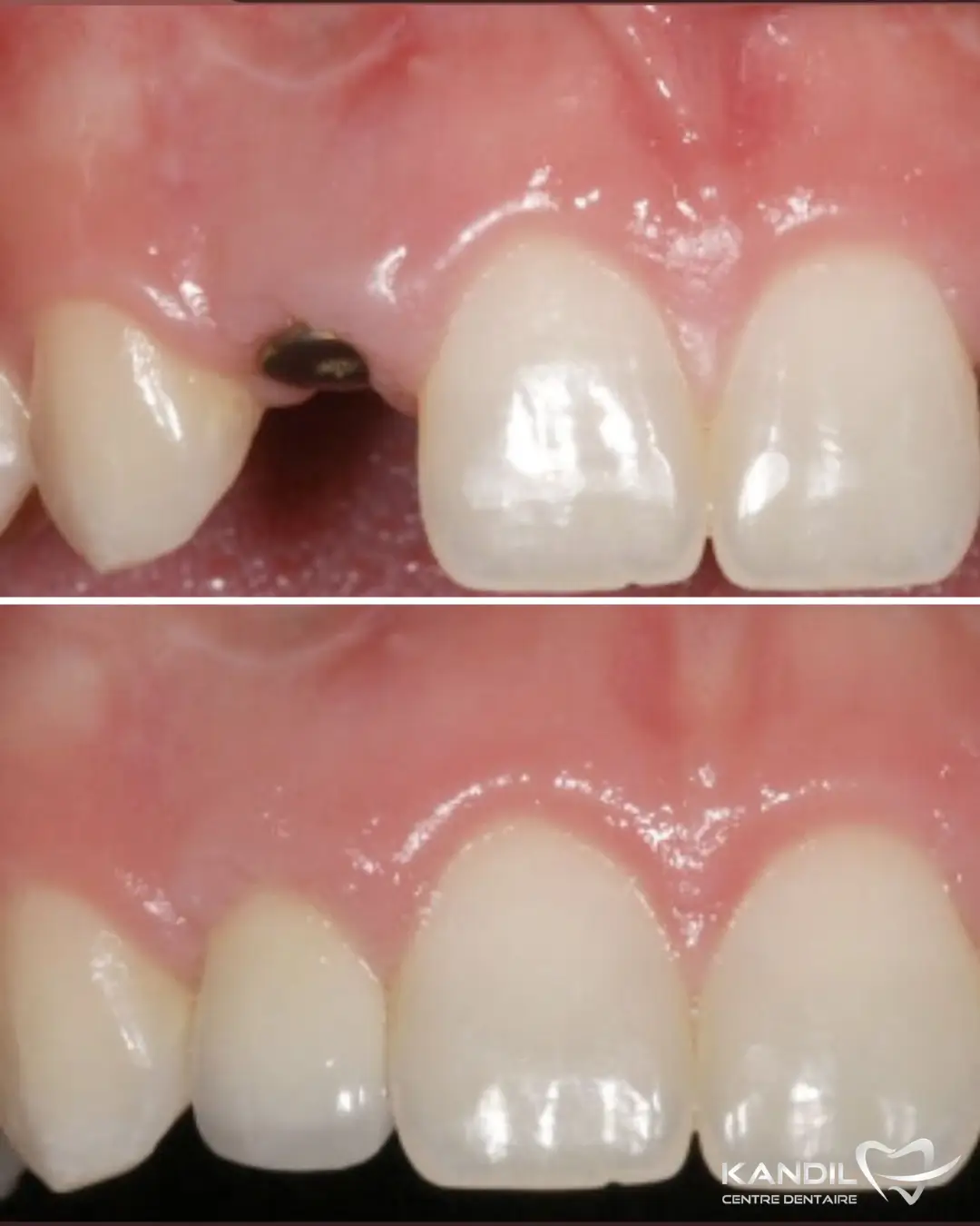 Détail avant-après d'une chirurgie implantaire montrant le pilier de cicatrisation de l'implant, suivi de la pose de la couronne dentaire finale. Intégration esthétique et biologique de haute précision au Centre Dentaire Kandil à Mohammedia.