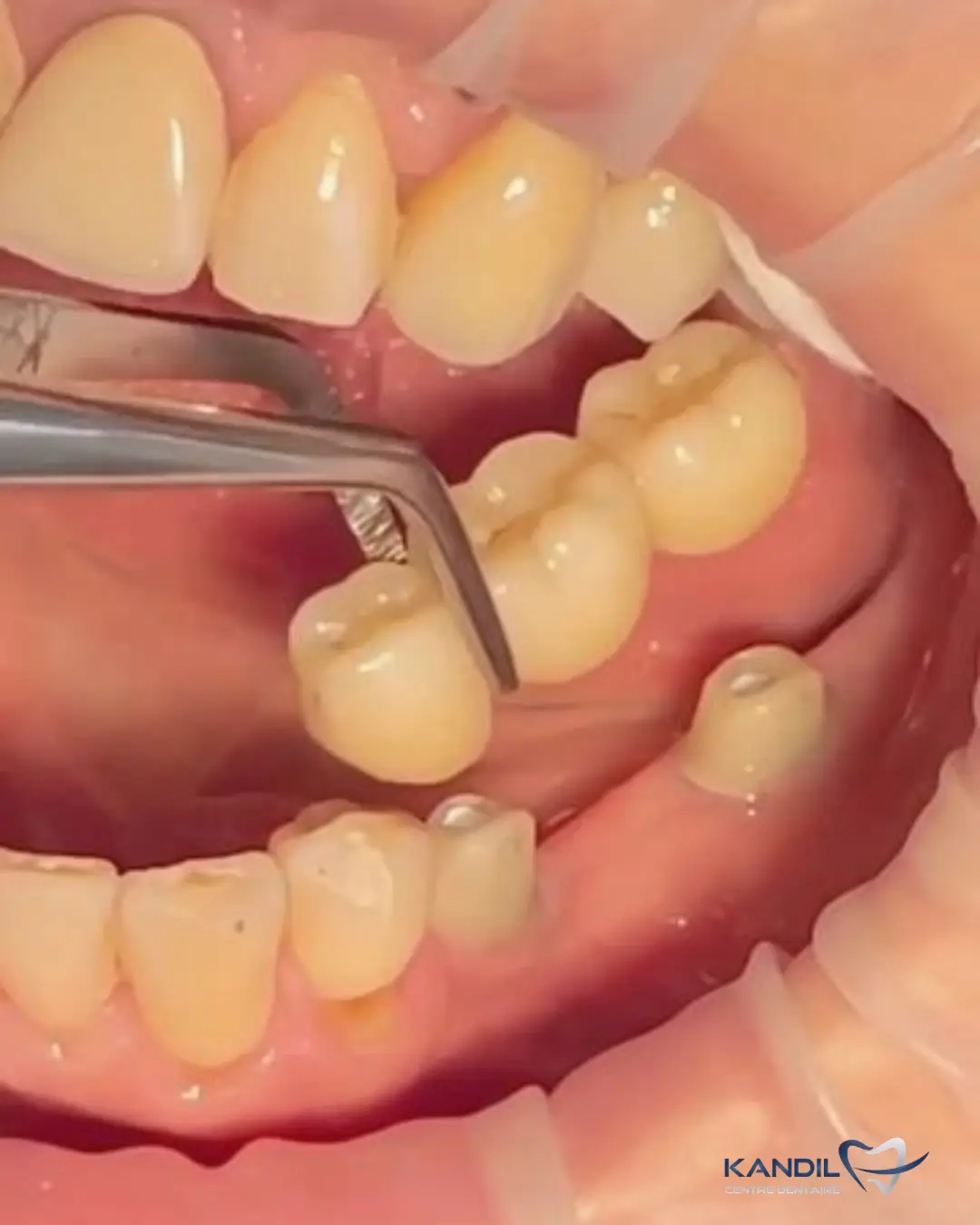 Pose clinique d'un bridge dentaire en céramique sur dents piliers pour remplacer des dents manquantes. Vue de la mise en place de la prothèse fixe au Centre Dentaire Kandil à Mohammedia.