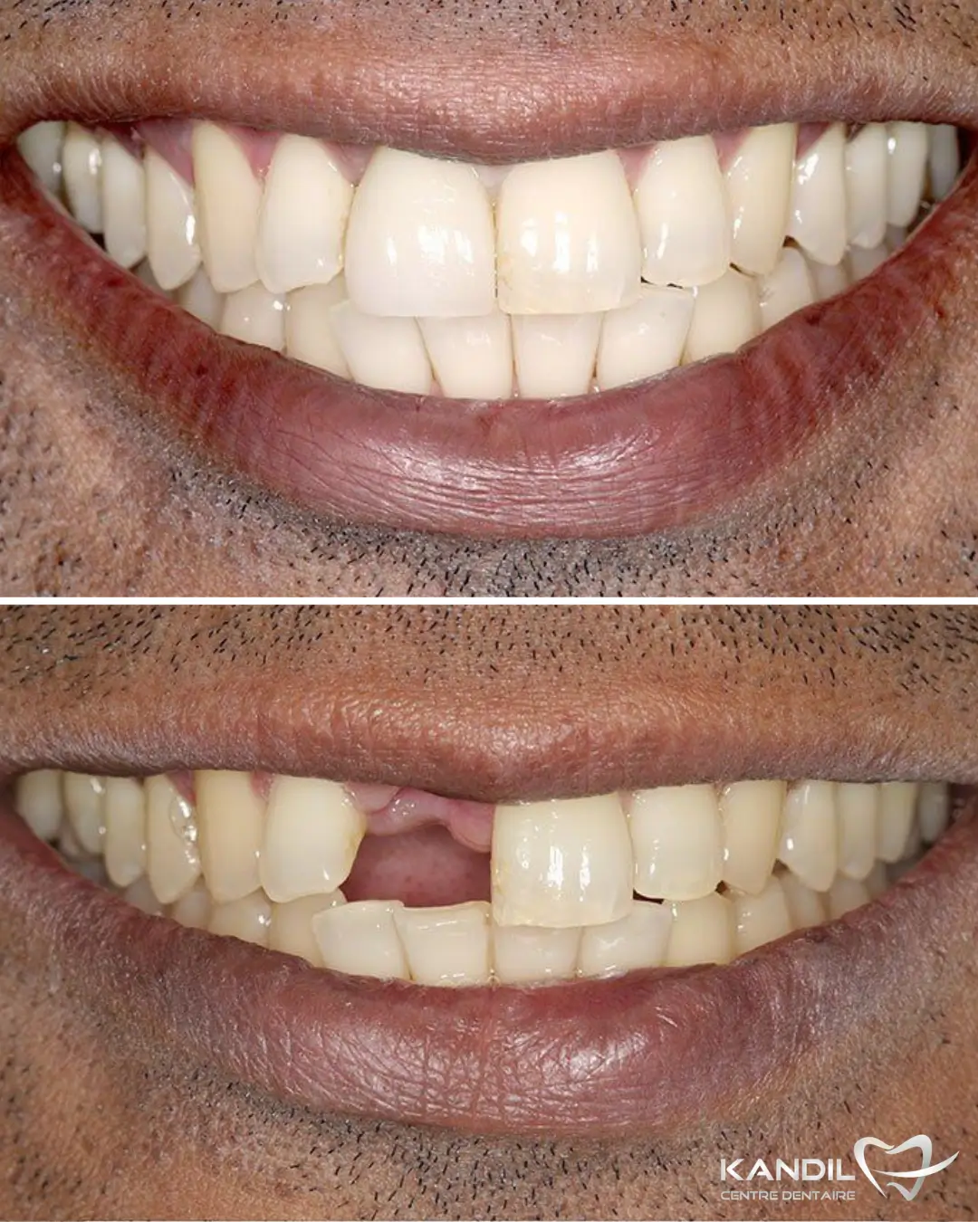 Restauration de sourire avant-après grâce à la pose d'un implant dentaire suite à la perte d'une dent de devant. Le résultat montre un alignement naturel et harmonieux réalisé par le Centre Dentaire Kandil à Mohammedia.