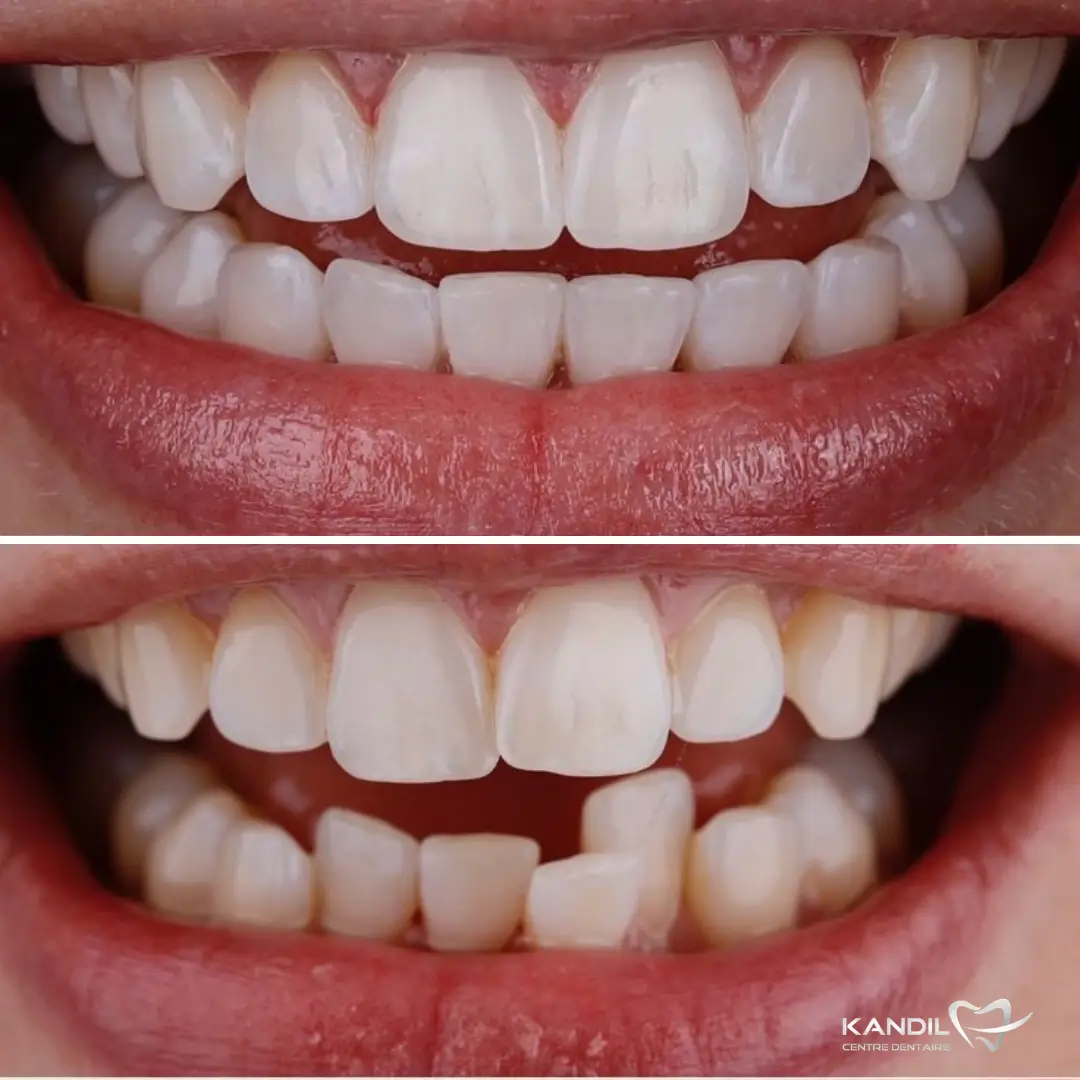 Cas clinique avant-après d'un traitement d'orthodontie invisible Invisalign au Centre Dentaire Kandil à Mohammedia. Alignement complet des dents inférieures et correction du chevauchement dentaire sans bagues.