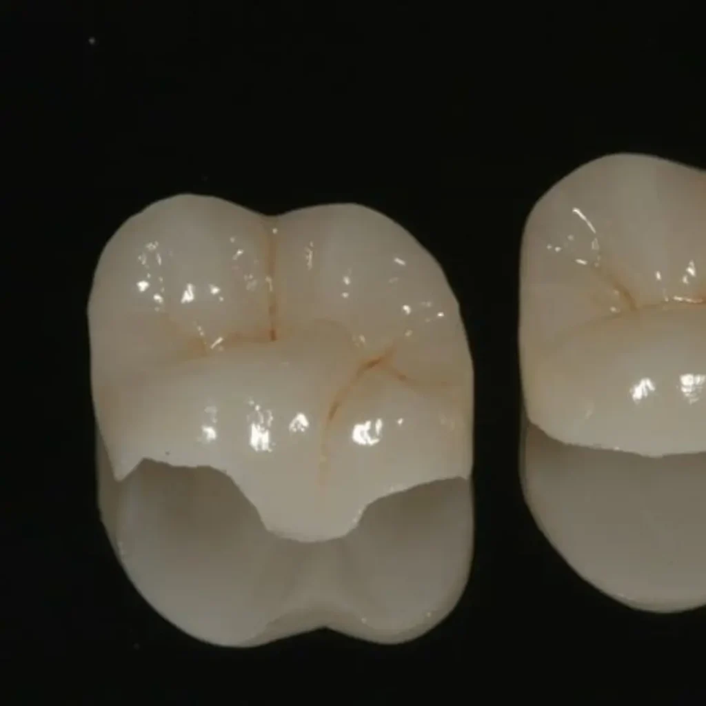 Deux couronnes dentaires en zircone teinte naturelle pour molaires, Centre Dentaire Kandil au Maroc