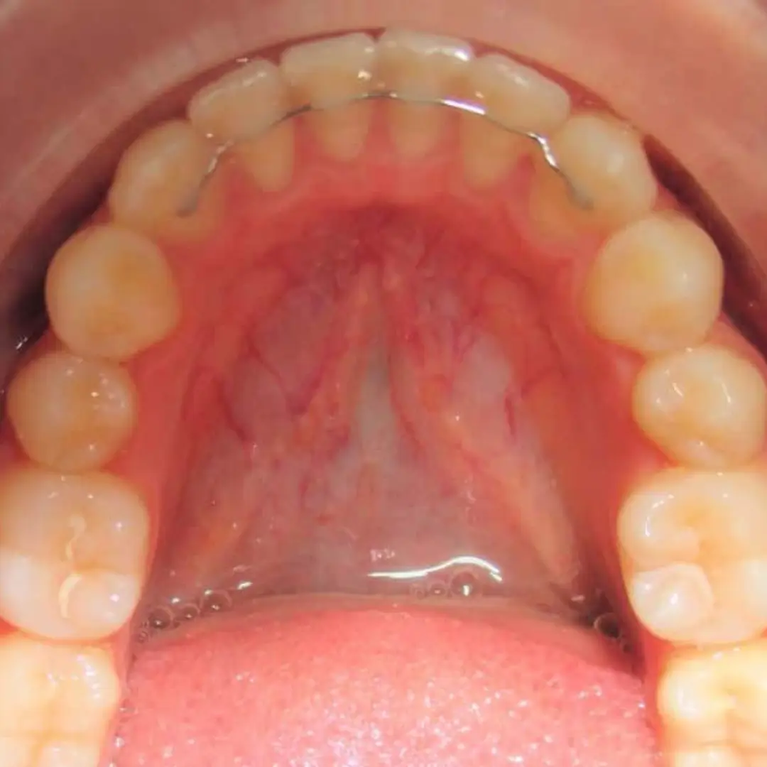 contention orthodontique chez centre dentaire kandil à mohammedia BD palestine